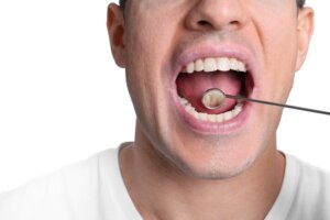 Saúde Bucal: Como prevenir o câncer de boca e orofaringe