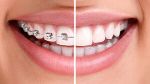 Saúde Bucal: Quem tem facetas e coroas dentais pode usar aparelhos ortodônticos?