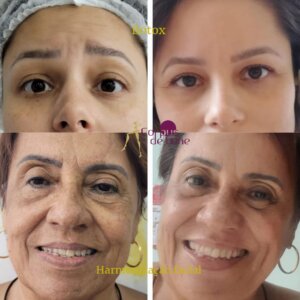 Estética1Luxuosa: Harmonização facial e botox: é a mesma coisa?