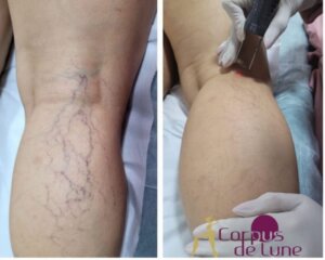 Estética1Luxuosa: Cansada dos vasinhos? Veja como o laser pode ser seu aliado