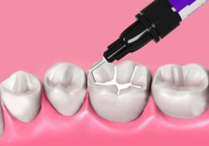 Saúde Bucal: Selantes dentários: prevenção da cárie dentária