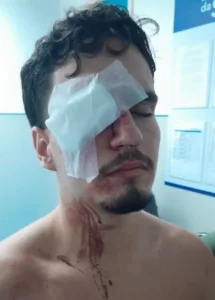 Torcedor do Vasco atingido por bala de borracha corre risco de perder visão