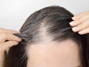 Efeito “Ozempic” no cabelo preocupa especialistas e impulsiona mercado de produtos para fios finos