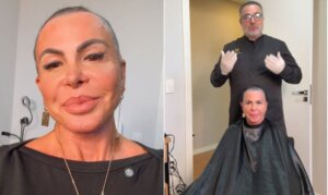 Gretchen raspa a cabeça e transforma transplante capilar em campanha de conscientização sobre alopecia feminina